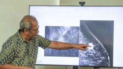 Dokter Ingatkan Waspadai Ciri-Ciri Kanker Payudara 