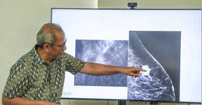 Dokter Ingatkan Waspadai Ciri-Ciri Kanker Payudara 